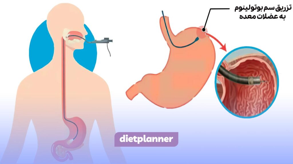 تزریق سم بوتولینوم نوع A به عضلات معده