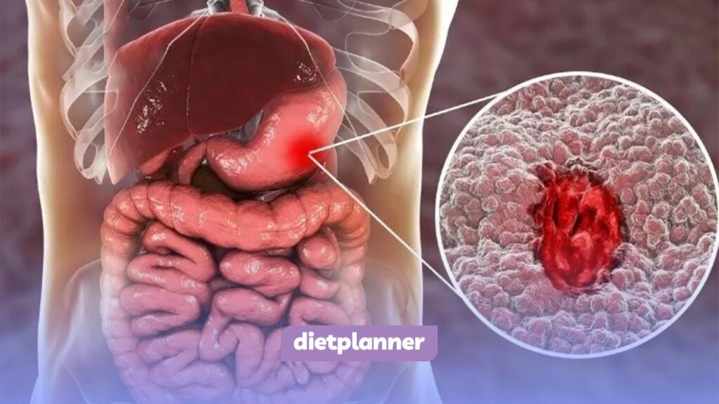 پوسیدگی معده و سوراخ شدن
