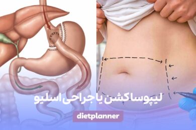 لیپوساکشن یا جراحی اسلیو