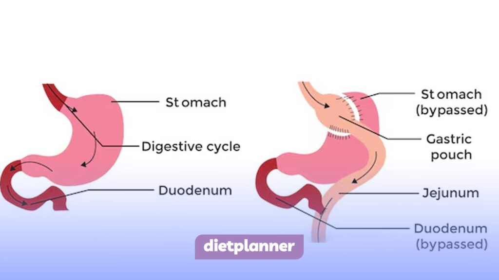 جراحی لاغری بای پس معده