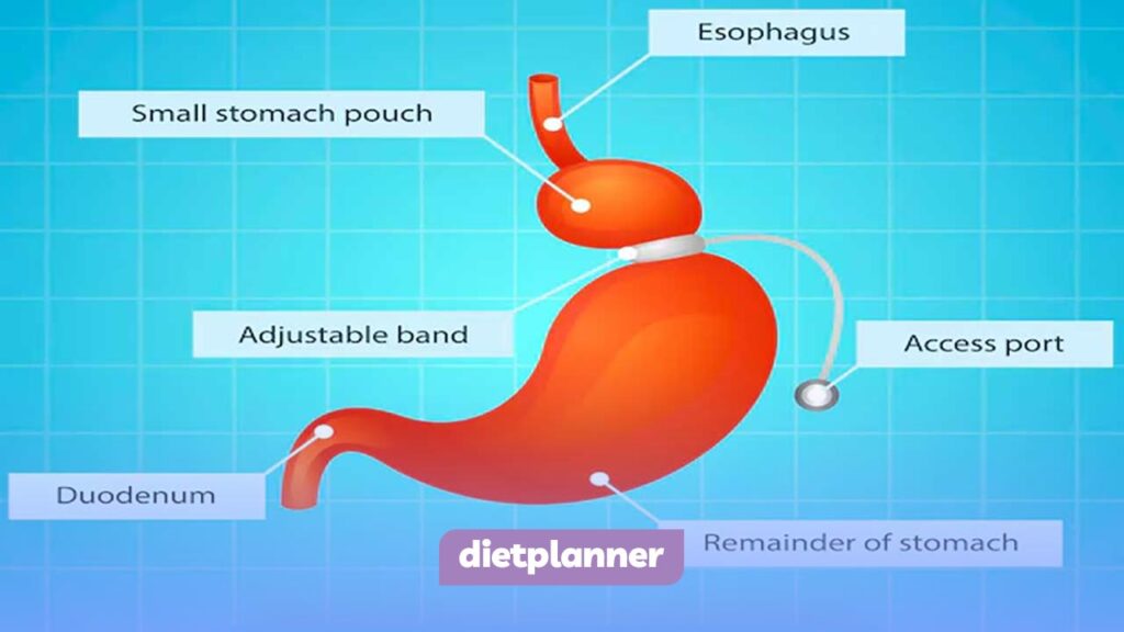 جراحی باندینگ معده