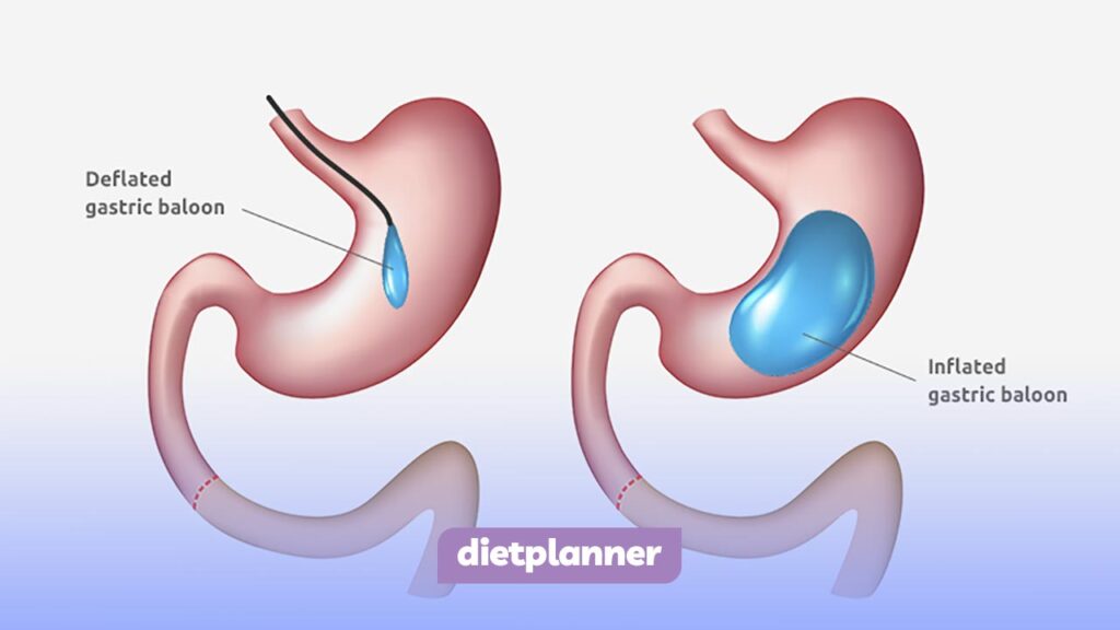 عمل بالن معده